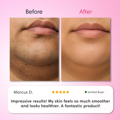 Hair Removal Trilogy Kit